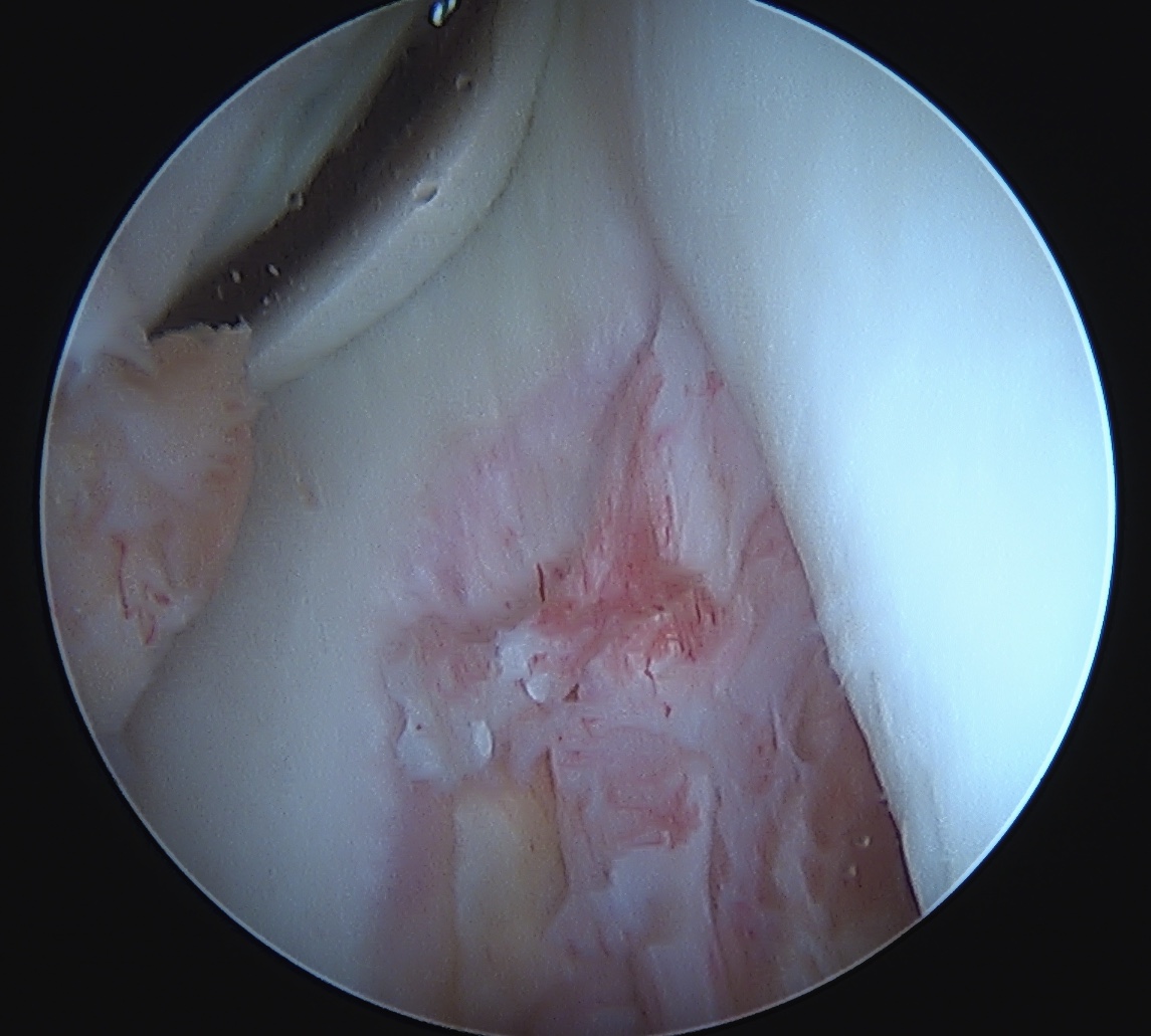 PCL femoral avulsion